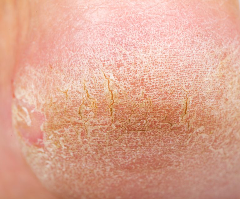 Common Foot Conditions